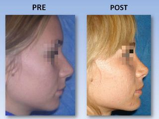 Rinoplastia