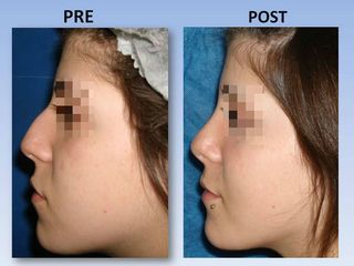 Rinoplastia