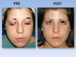 Rinoplastia