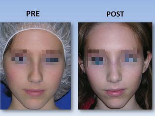 Rinoplastia