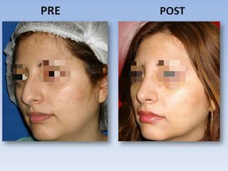 Rinoplastia