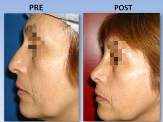 Rinoplastia