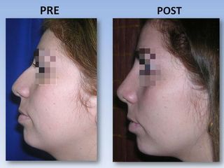 Rinoplastia