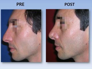 Rinoplastia