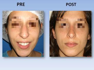 Rinoplastia