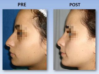 Rinoplastia