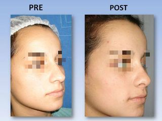 Rinoplastia