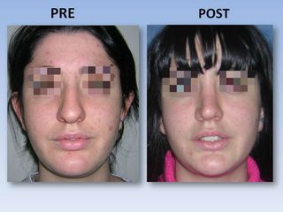 Rinoplastia