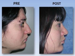 Rinoplastia