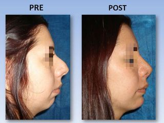 Rinoplastia