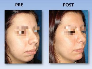 Rinoplastia