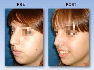 Rinoplastia