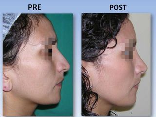 Rinoplastia