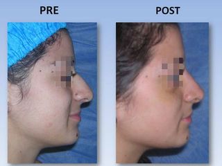 Rinoplastia