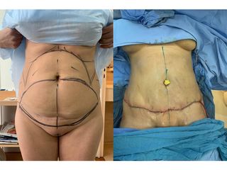 Abdominoplastia - Dr. Carlos Arce