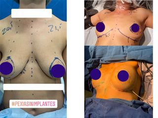 Mastopexia - Dr. Carlos Arce