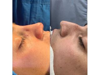 Rinoplastia - Dr. Carlos Arce