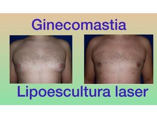 Ginecomastia - Dr. Carlos Arce