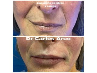 Relleno de labios - Dr. Carlos Arce