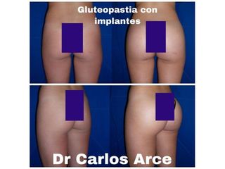 Aumento glúteos - Dr. Carlos Arce