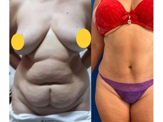 Abdominoplastia - Dr. Carlos Arce