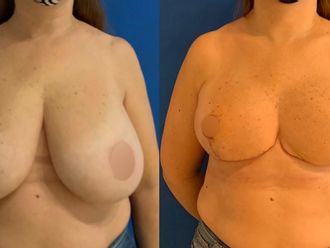 Reducción de mamas-742581