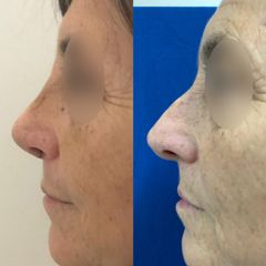 Rinoplastia - Dr. Carlos Arce