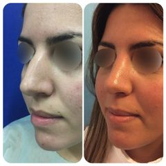 Rinoplastia - Dr. Carlos Arce