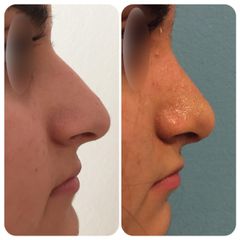 Rinoplastia - Dr. Carlos Arce