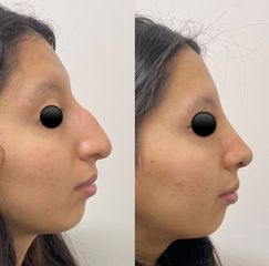 Rinoplastia - Dr. Carlos Arce