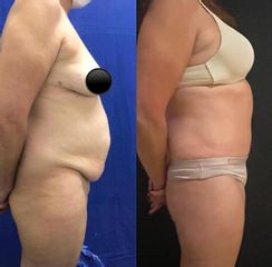 Abdominoplastia - Dr. Carlos Arce