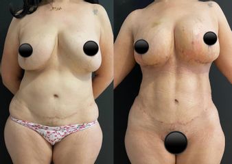 Mastopexia - Dr. Carlos Arce