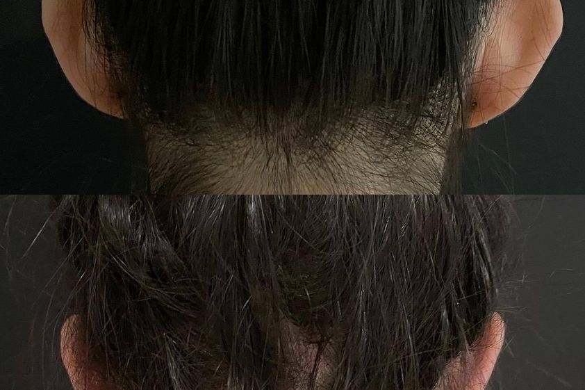 Otoplastia antes y después - 849542
