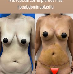 Lipoescultura - Dr. Carlos Arce