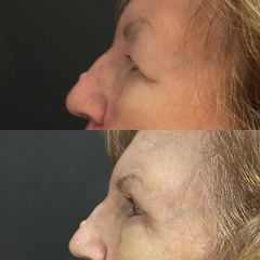 Blefaroplastia - Dr. Carlos Arce