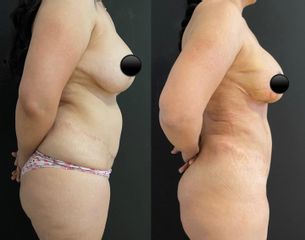 Mastopexia - Dr. Carlos Arce