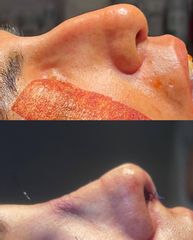 Rinoplastia - Dr. Carlos Arce