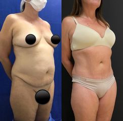 Abdominoplastia - Dr. Carlos Arce