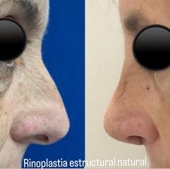 Rinoplastia - Dr. Carlos Arce