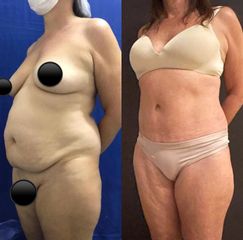 Abdominoplastia - Dr. Carlos Arce