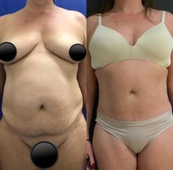 Abdominoplastia - Dr. Carlos Arce