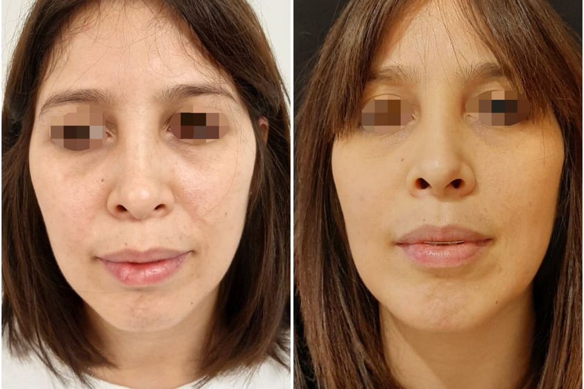 Mentoplastia antes y después - 689718