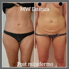 Minidermo - Mw Estética