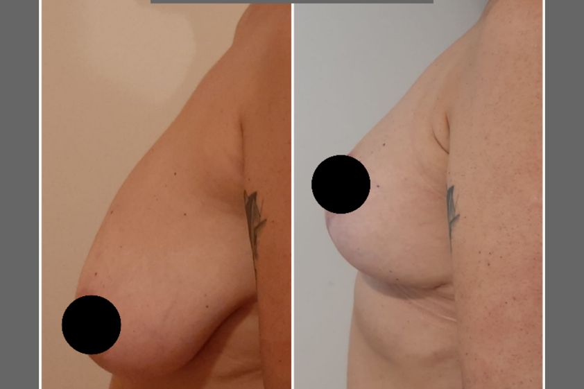 Mastopexia antes y después - 697102