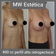 Aumento mamas - Mw Estética