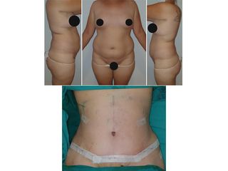 Abdominoplastia - Mw Estética