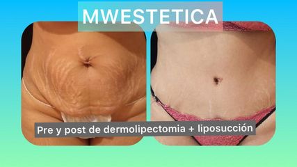 Dermolipectomía - Mw Estética