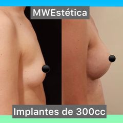 Aumento mamas - Mw Estética