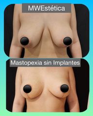Reducción de mamas - Mw Estética