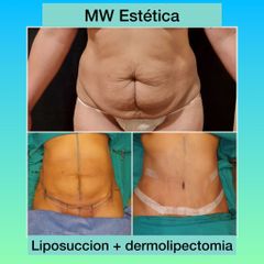 Liposucción - Mw Estética